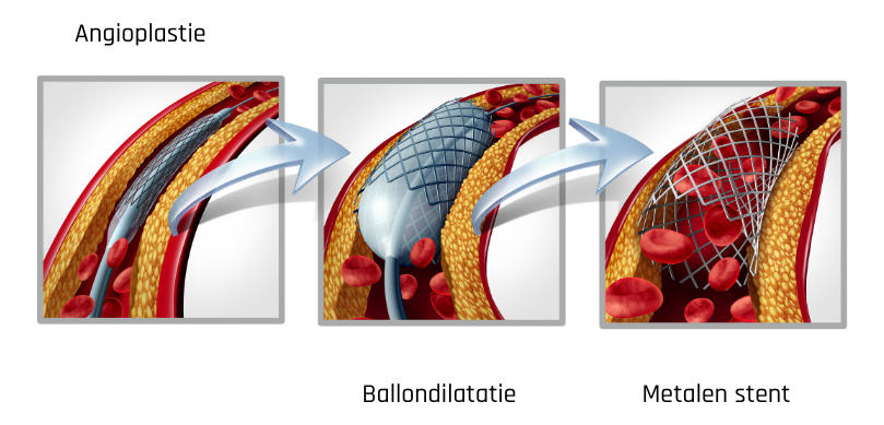 Chirurgische ingrepen bij slechte doorbloeding in de benen (claudicatio